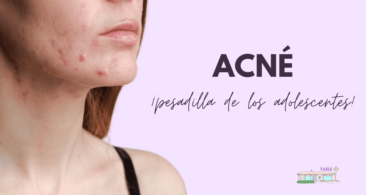 Acné. Pesadilla número 1 en adolescentes