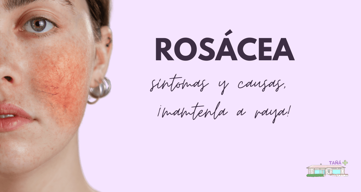 Rosácea: síntomas y causas