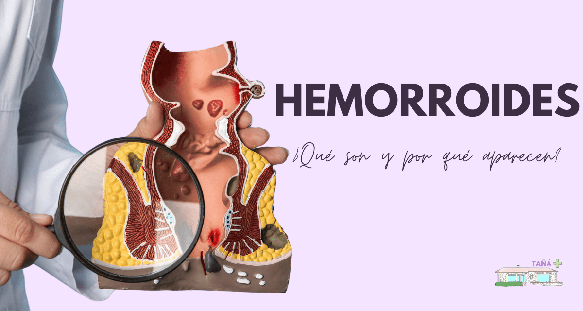 Síntomas y tratamiento adecuado de las hemorroides