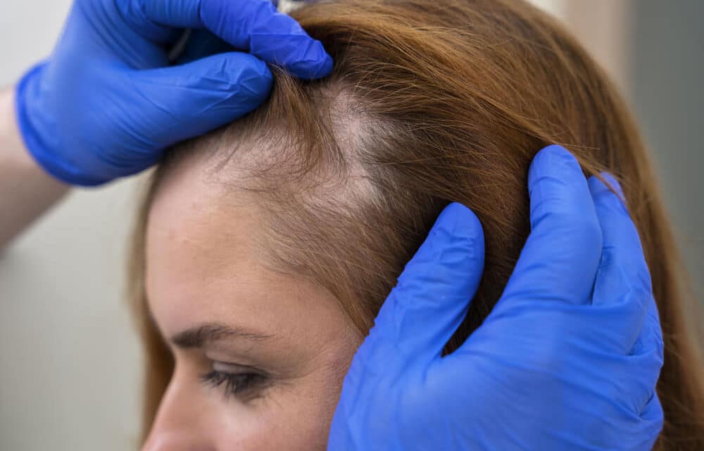 ¿Cuáles son los tipos de alopecia? Síntomas, causas y tratamiento