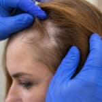 ¿Cuáles son los tipos de alopecia? Síntomas, causas y tratamiento