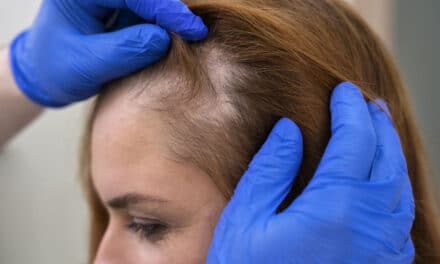 ¿Cuáles son los tipos de alopecia? Síntomas, causas y tratamiento