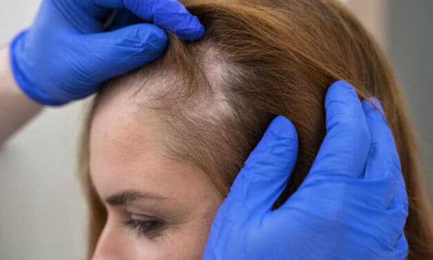 ¿Cuáles son los tipos de alopecia? Síntomas, causas y tratamiento