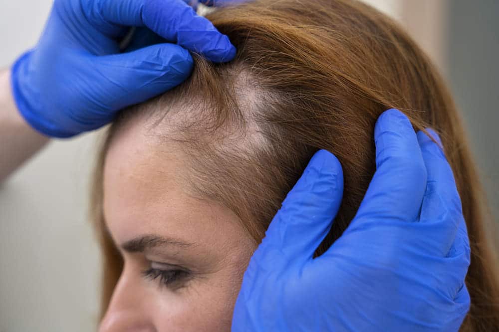 ¿Cuáles son los tipos de alopecia? Síntomas, causas y tratamiento