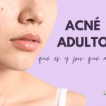 Acné adulto: causas, tratamiento y consejos