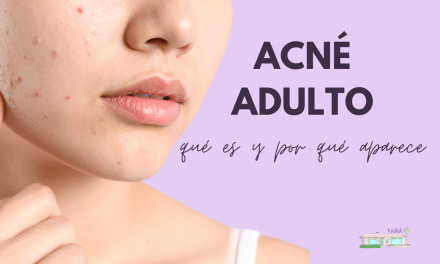 Acné adulto: causas, tratamiento y consejos