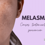 ¿Qué es Melasma? Causas, tratamiento y prevención de las manchas faciales