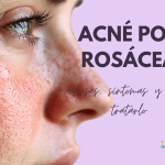 Acné por rosácea: causas, síntomas y cómo tratarlo