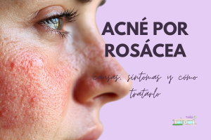 Acné por rosácea: causas, síntomas y cómo tratarlo