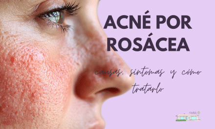 Acné por rosácea: causas, síntomas y cómo tratarlo
