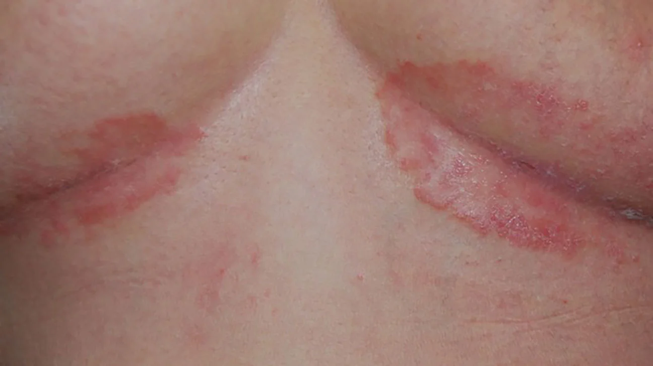 Psoriasis inversa