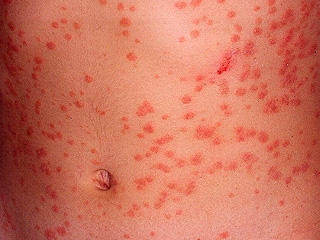 Psoriasis en gota