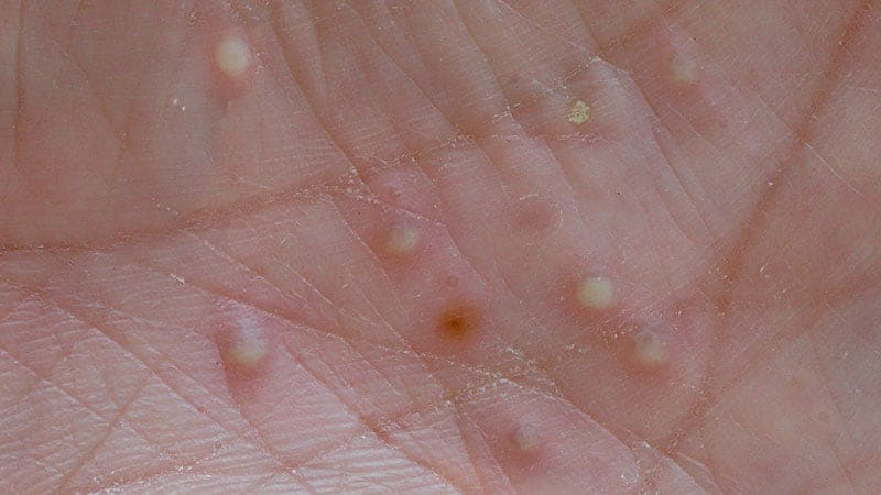 Psoriasis pustulosa