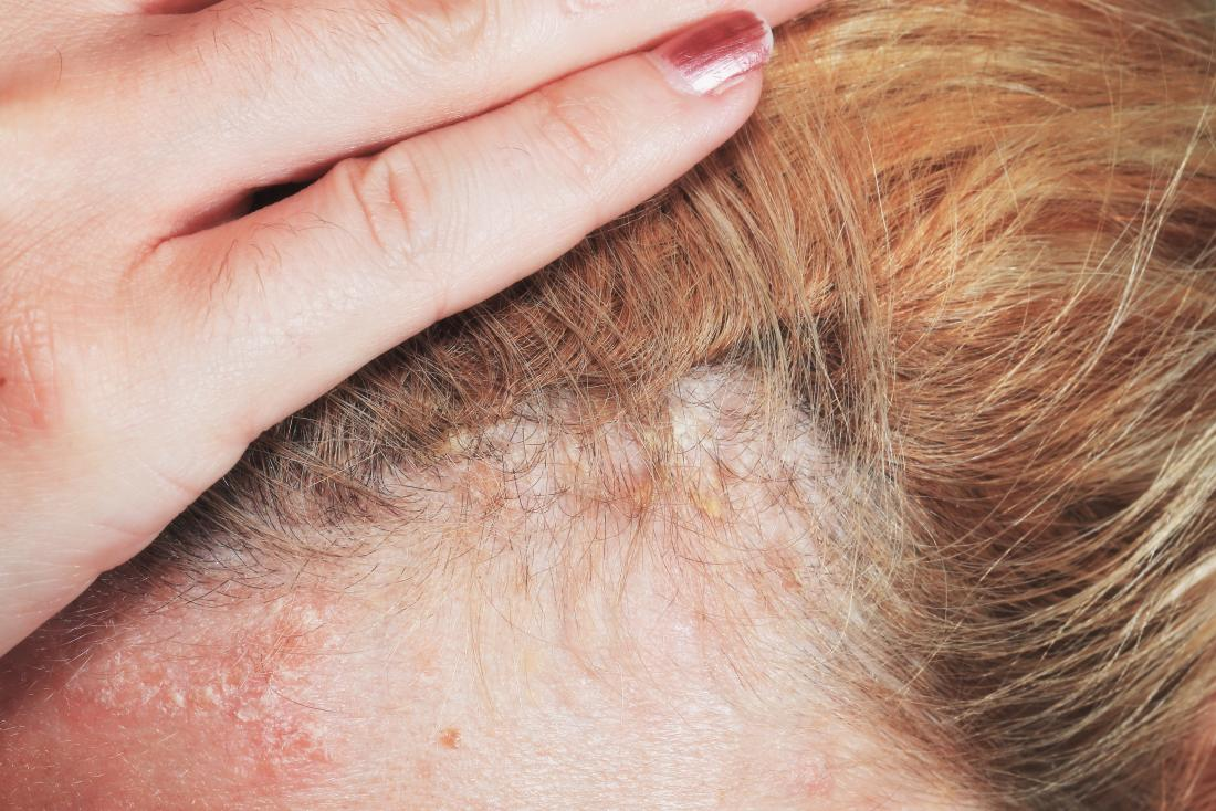 Psoriasis en la cabeza