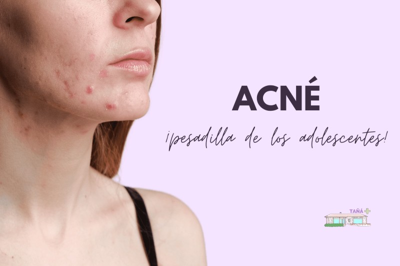 ACNÉ