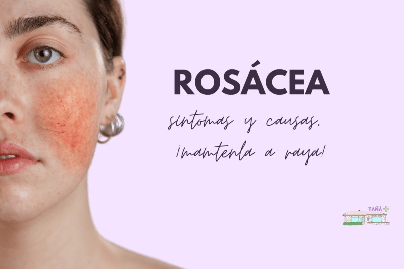 Rosácea