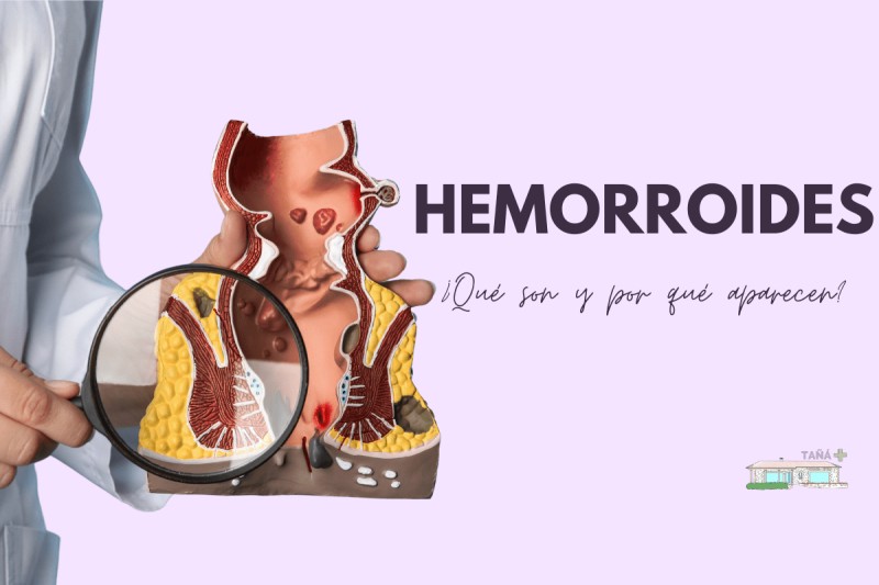 hemorroides