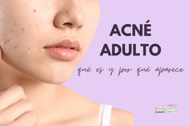 acne adulto