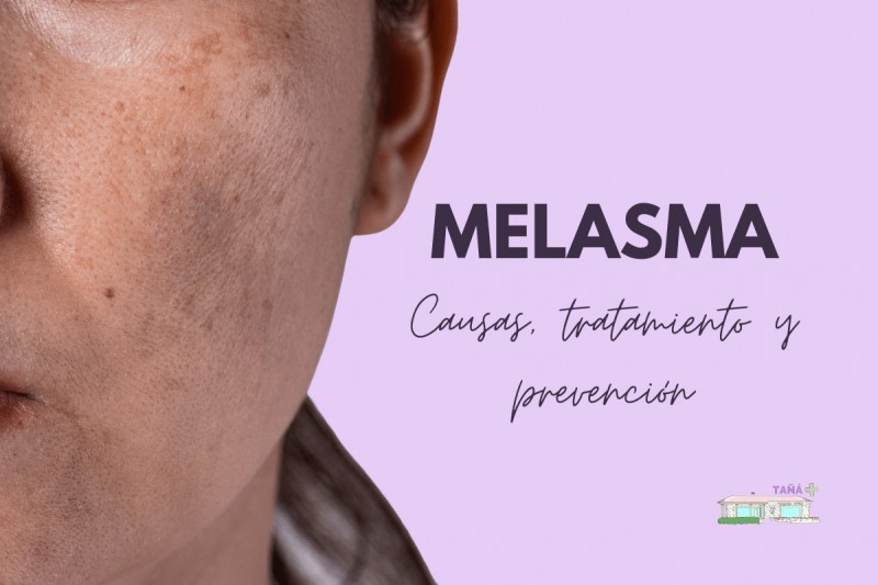 melasma