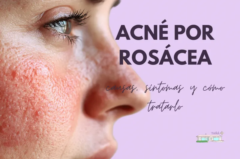 acne rosacea